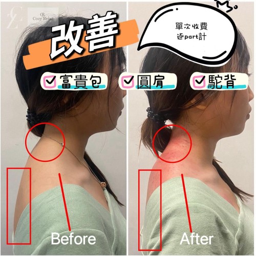 改善富貴包/圓肩/駝背